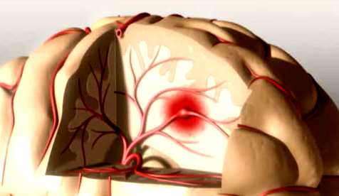 Bệnh tai biến mạch máu não một trong những căn bệnh nguy hiểm nhất thế giới