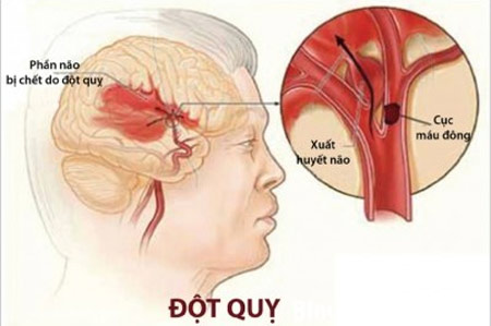 Bệnh tai biến mạch máu não thì thường xảy ra ở nam giới hay nữ giới